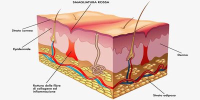 關于IPL光子脫毛的幾大問題（上）