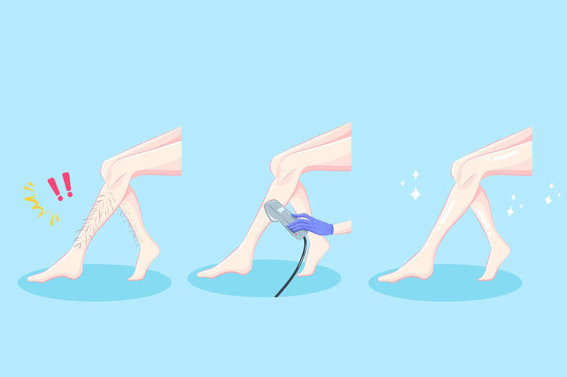 使用光子脫毛儀會讓毛孔變大嗎?(圖3) 脫毛儀器生產廠家