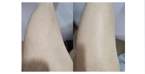 如何擺脫體毛濃密的困擾?體毛濃密女孩過來看看(圖2) 如何擺脫體毛濃密的困擾?體毛濃密女孩過來看看(圖2)