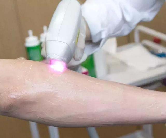 家用光子脫毛儀種草指南(圖1)