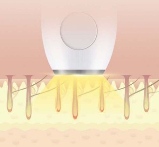 脫毛儀廠家諾鉑為您解疑：關于激光脫毛的六大問題