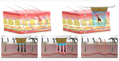 永久脫毛有哪些方式和對比效果(圖2)