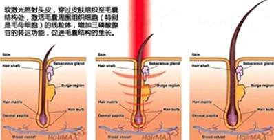 永久脫毛有哪些方式和對比效果(圖1)