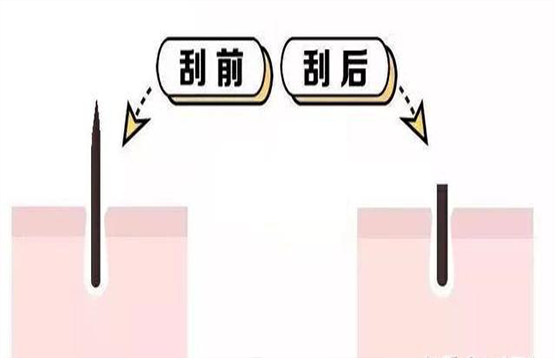 脫毛不徹底,毛毛的生命力到底有多頑強(qiáng)?(圖3) 脫毛不徹底,毛毛的生命力到底有多頑強(qiáng)?(圖3)