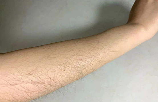 如何選擇一款有效的脫毛儀(圖1) 如何選擇一款有效的脫毛儀(圖1)