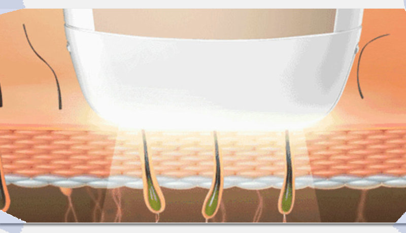 脫毛儀的選擇,冰點脫毛儀優先(圖2) 脫毛儀的選擇,冰點脫毛儀優先(圖2)