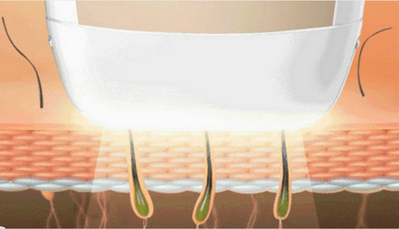 市面上的脫毛儀真的有用嗎(圖1) 市面上的脫毛儀真的有用嗎(圖1)